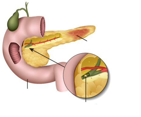 pankreatit är en inflammation i bukspottkörteln